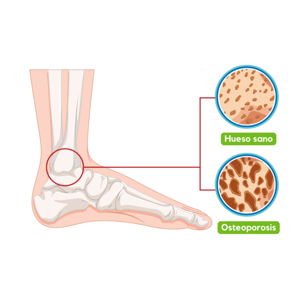 osteoporosis